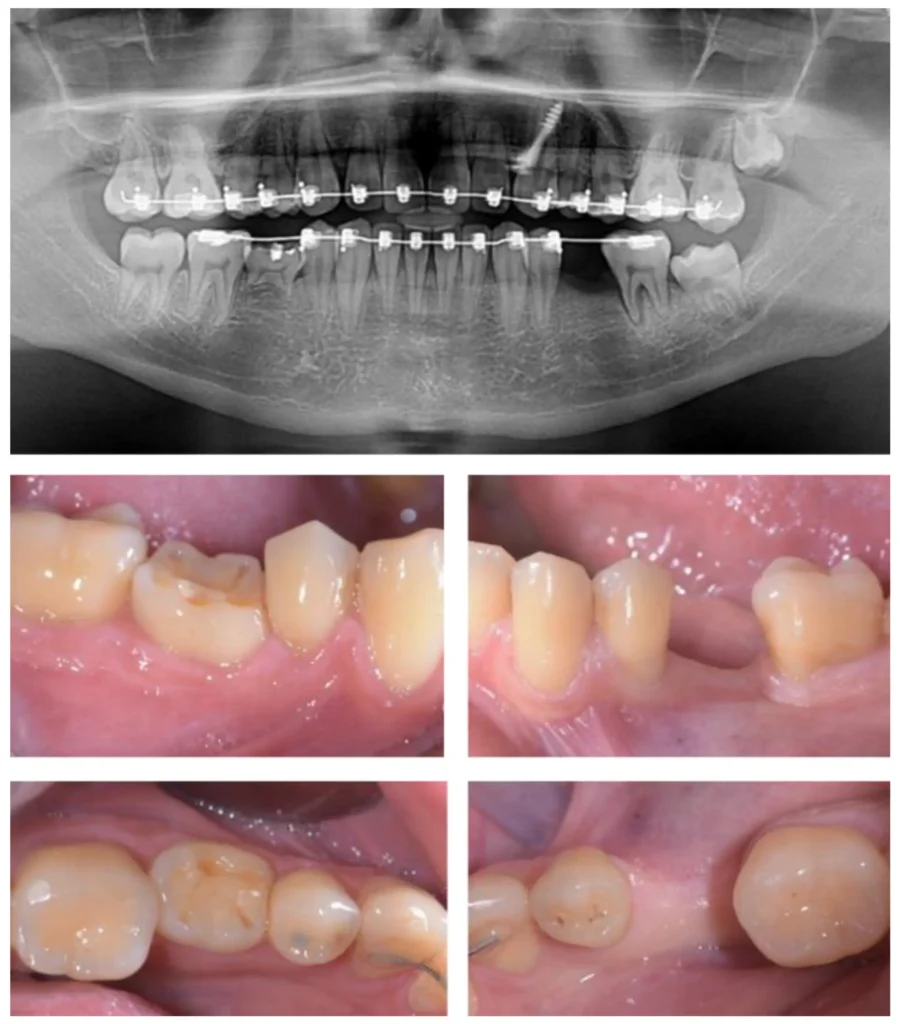 Why Timing Matters Early vs. Delayed Dental Implant Placement